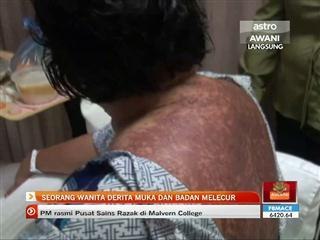 Seorang wanita derita muka dan badan melecur