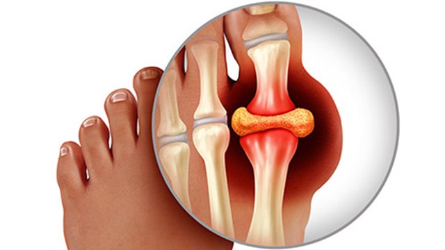 गठिया से जूझ रहे लोगो के लिए रामबाण इलाज है ये उपाय । Boldsky
