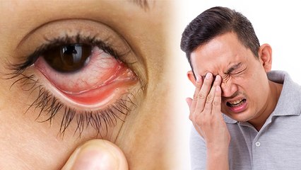आंखों में आंसू न आना Dry Eye Syndrome के लक्षण,क्या है कारण और बचाव | Boldsky