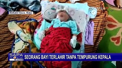 Kisah Bayi Usia 8 Hari yang Terlahir Tanpa Memiliki Tempurung Kepala, Butuh Uluran Tangan