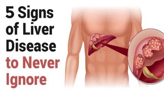 ये 5 लक्षण नजर आएं, तो समझो लिवर खराब है | 5 Early Signs of Liver Damage |