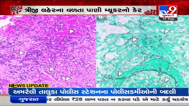 Mucormycosis Returns! 18 cases reported in Ahmedabad Civil hospital_ TV9News