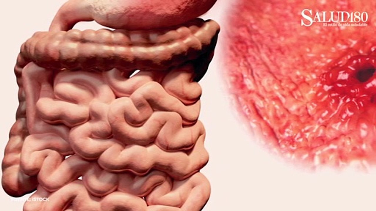 Perforación Gastrointestinal; 4 padecimientos "preocupantes" | Salud180