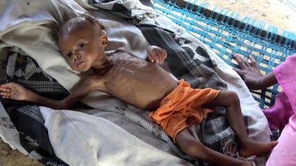 بالفيديو: الموت جوعا يهدد الطفلة رندا وملايين اليمنيين بسبب نقص المساعدات