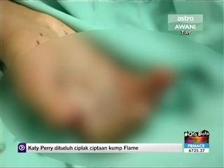 Putus 2 jari akibat mercun