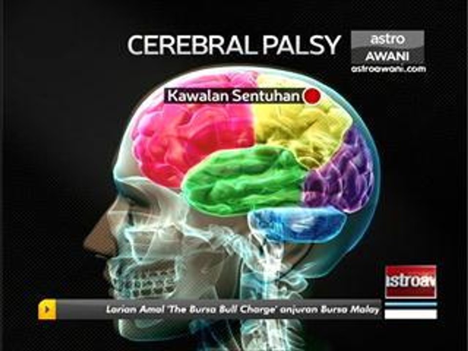 Apa itu Cerebral Palsy