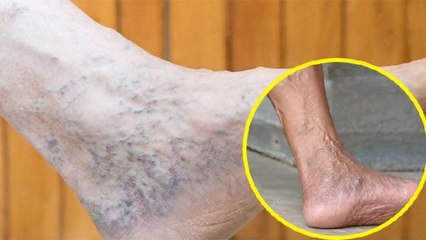 नसों में सूजन क्यों आती है? जाने कारण और बचाव | Boldsky