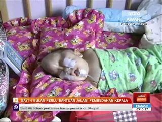 Bayi 4 bulan perlu bantuan jalani pembedahan kepala