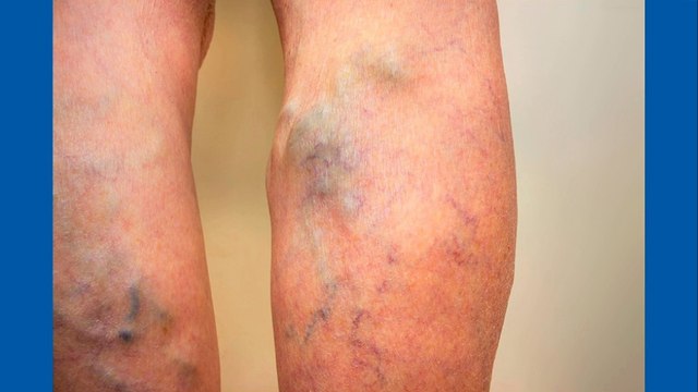 bd-alternativas-para-tratar-las-venas-varicosas-
