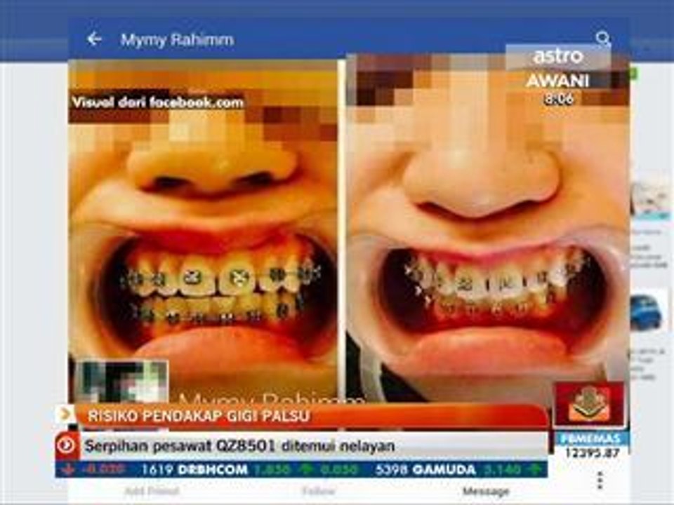 Risiko pendakap gigi palsu