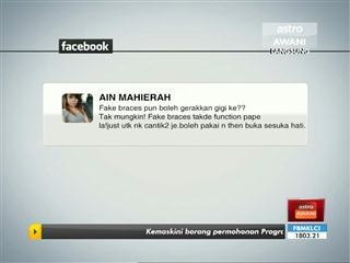 'Fake Braces' hanya trend dan suka-suka?