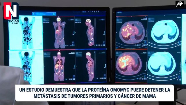 Científicos españoles crean un fármaco que frena la metástasis en cáncer de mama