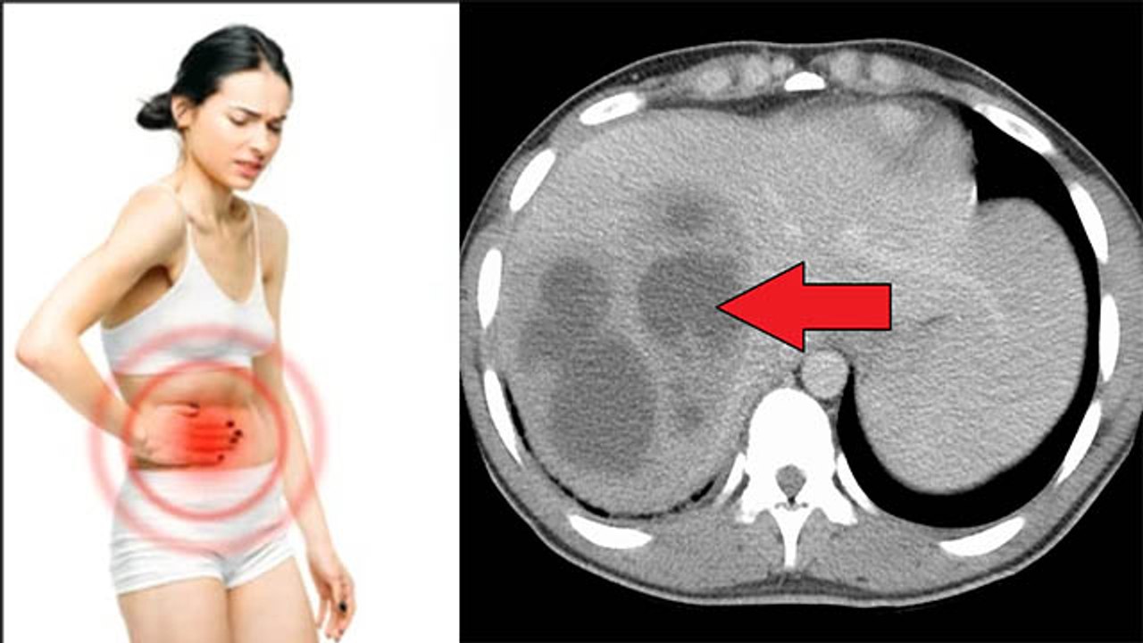 Liver Abscess क्या है | लिवर में मवाद का इलाज |...