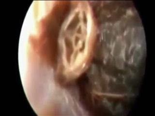 25 roaches crawl out of man's ear