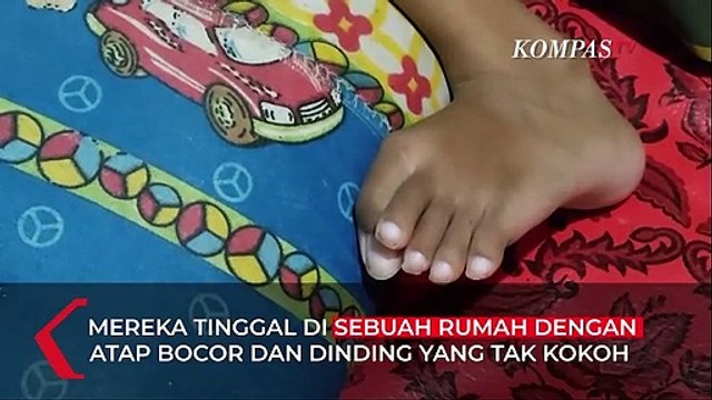 Kisah Dina, Anak Yatim Piatu dengan Gizi Buruk dan Stunting