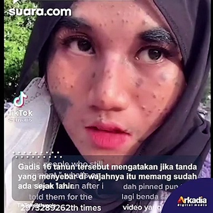 Viral Gadis Malaysia Dipenuhi Tanda Lahir di Wajah, Sering Diejek Tapi Malah Jadi Seleb  TikTok