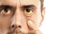 आंखो का पीलापन इस गंभीर बीमारी का लक्षण,Anemia से लेकर Kidney Failure तक का खतरा | Boldsky