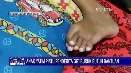 Kisah Rifka Dina Aulia, Bocah 7 Tahun Penderita Stunting Butuh Uluran Tangan