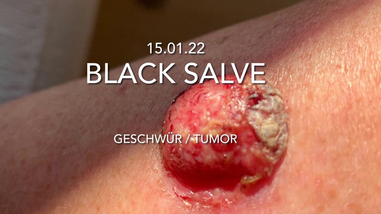 Teil 02 - Eigentherapie eines Geschwür / Tumor / Hautkrebs mit Schwarzer Salbe / Bioptron
