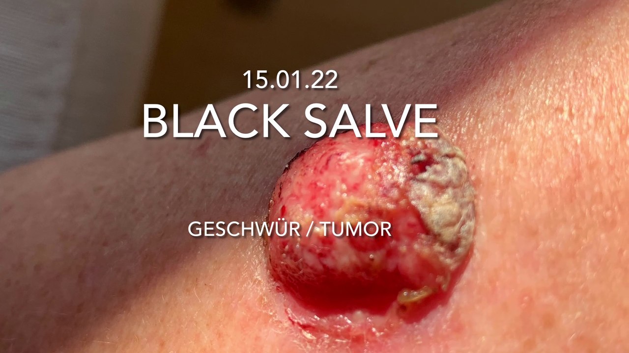 Teil 02 - eigentherapie eines geschwür / tumor / hautkrebs mit schwarzer salbe / bioptron