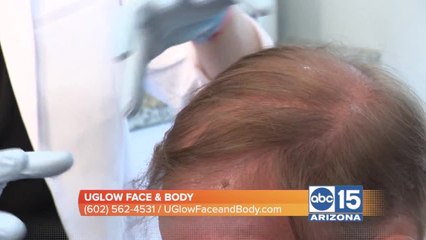 Hair loss? UGlow Aesthetics creates medical-grade PRP for hair restoration treatments