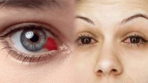 आंखे लाल होना Ocular Hypertension के Symptoms, क्या है कारण और बचाव | Boldsky