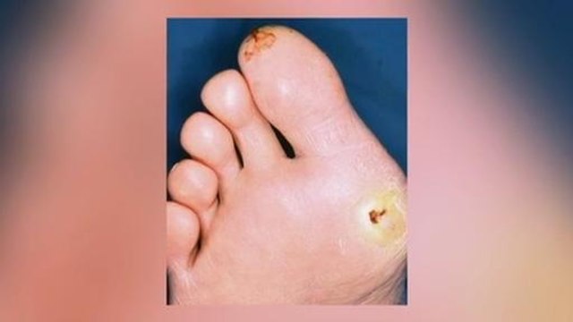 Cerita Sihat Nisa: Awasi luka di kaki