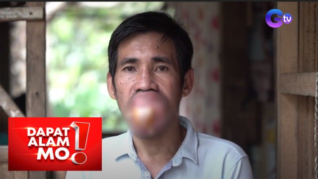 Dapat Alam Mo!: 43-anyos na tatay, hirap nang magsalita dahil sa malaking bukol sa bibig!