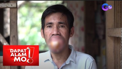 Dapat Alam Mo!: 43-anyos na tatay, hirap nang magsalita dahil sa malaking bukol sa bibig!