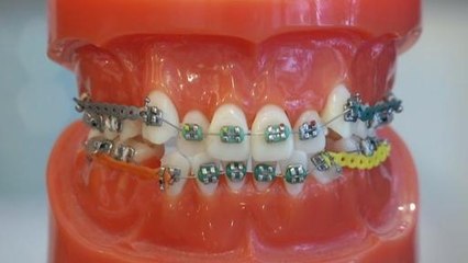 Cerita Sihat Nisa:  Braces, Trend & Impak