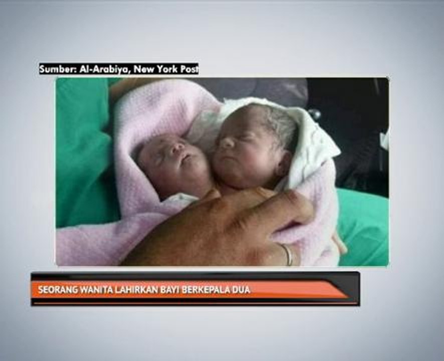 Seorang wanita lahirkan bayi berkepala dua