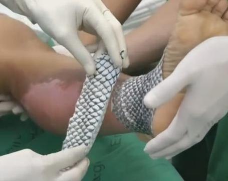 Brazilian doctors use fish skin to treat burn victims
