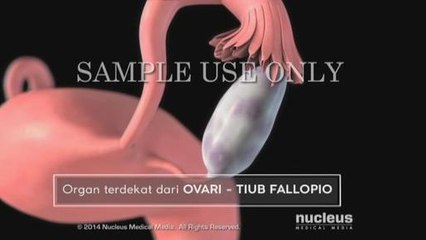 #CeritaSihatNisa (Episod 6) - Kanser OVARI: Apa yang perlu anda tahu & Dalami FilipinoMartialArt