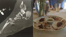 This Guy Literally Cooked His Own Foot And Served It To His Friends