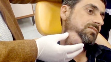 Doctor films the biggest pimple he's ever popped