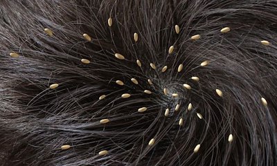 Bus passenger films a woman with a head full of lice