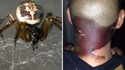 This Londoner's Skin Turned Black After He Was Bitten By A Spider In His Garden