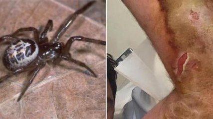 Spider Bite Turned Into A Life Threatening Situation For This Brit