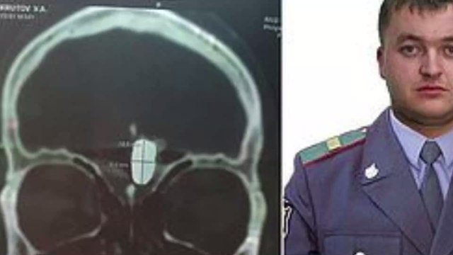 Russian Police Officer Has Been Living With a Bullet in His Brain for Over 10 Years