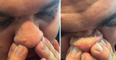 This is why pimple popping videos are so satisfying to watch