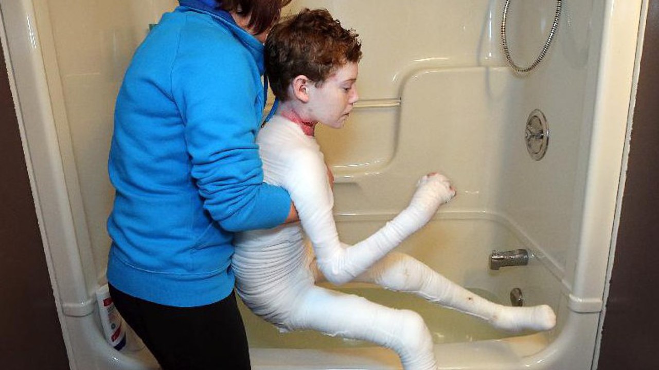 Known as the 'Butterfly Child', this Canadian boy is fighting a disease you’ve never heard of before