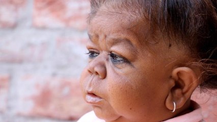 Due to his condition this man is considered to be a living Hindu God