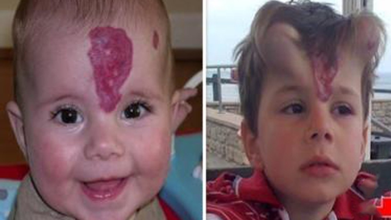 Wegen Muttermal entscheidet sich Mutter für eine OP: Dann hat ihr Kind plötzlich Hörner!