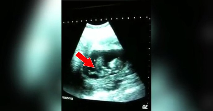 Parents laughed when they saw their baby doing this during and ultrasound