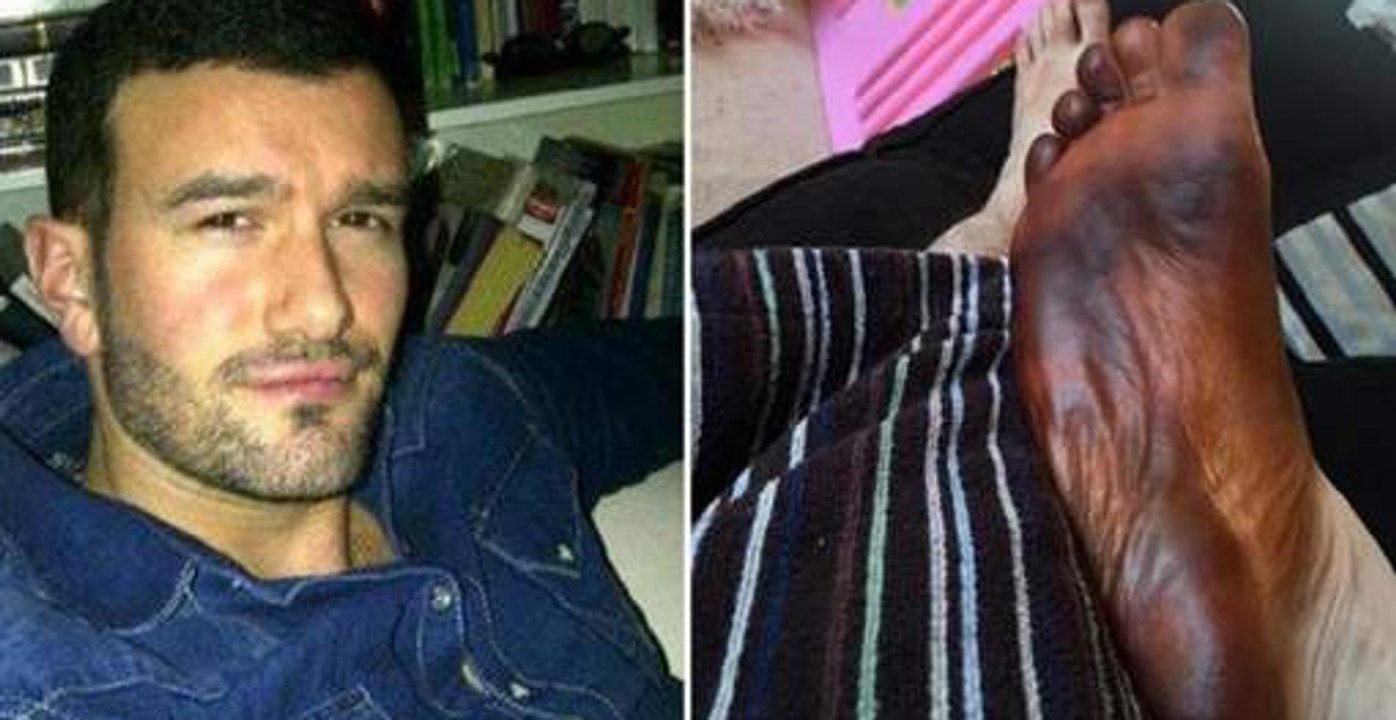 This man was left terrified after discovering his foot was completely black