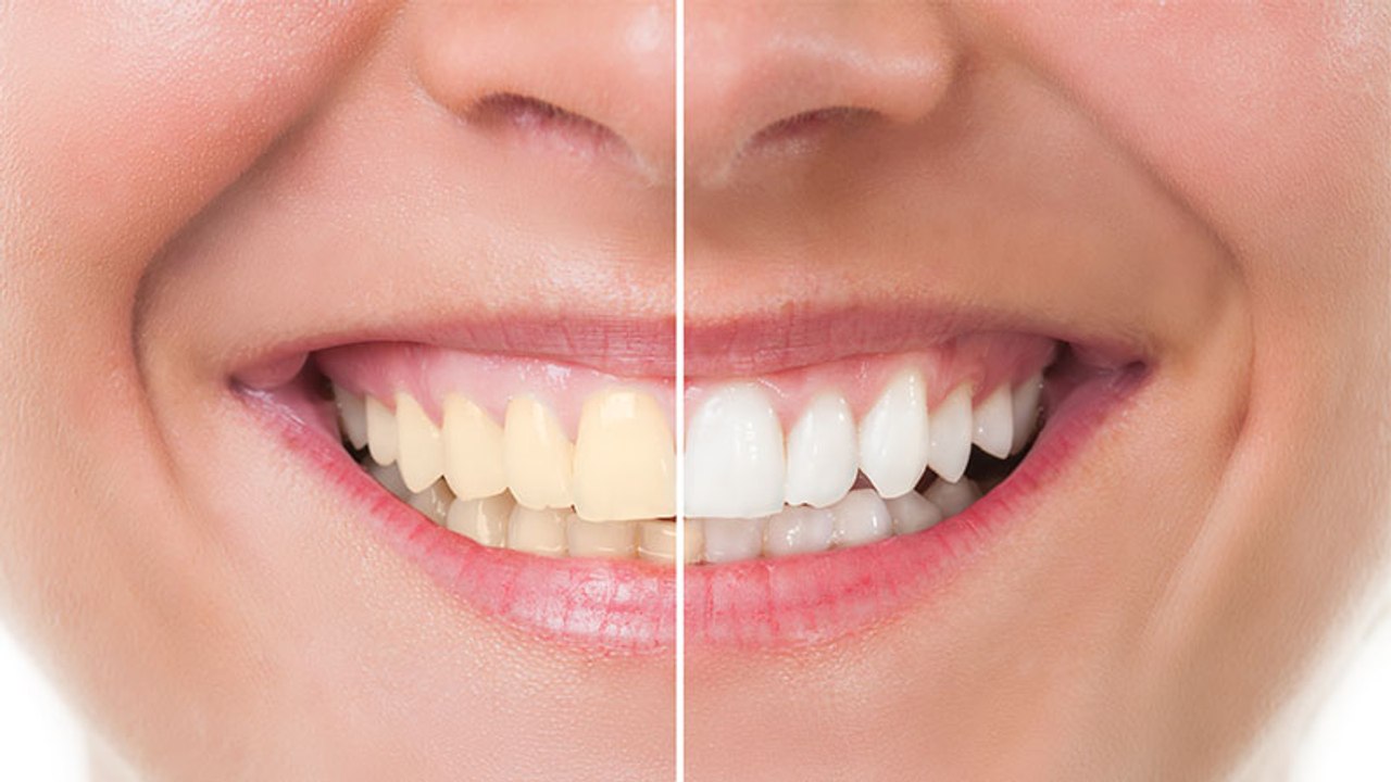 Mit diesem natürlichen Mittel werden eure Zähne wieder strahlend weiß!