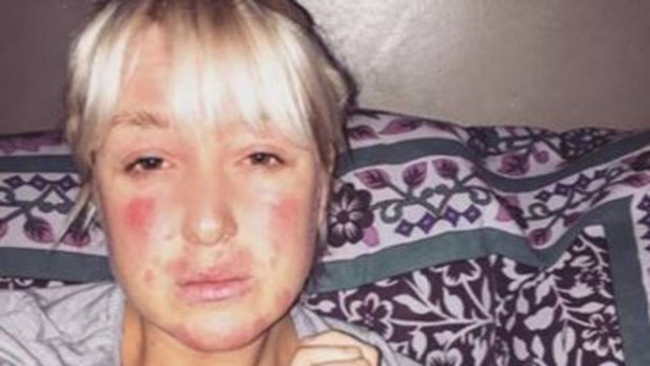 Frau mit schwerer Tierhaar-Allergie rettet Hunderten Vierbeinern das Leben