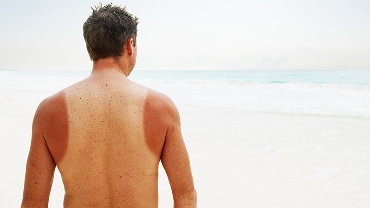 Hausmittel bei Sonnenbrand: Diese Mittel hat jeder bei sich zu Hause