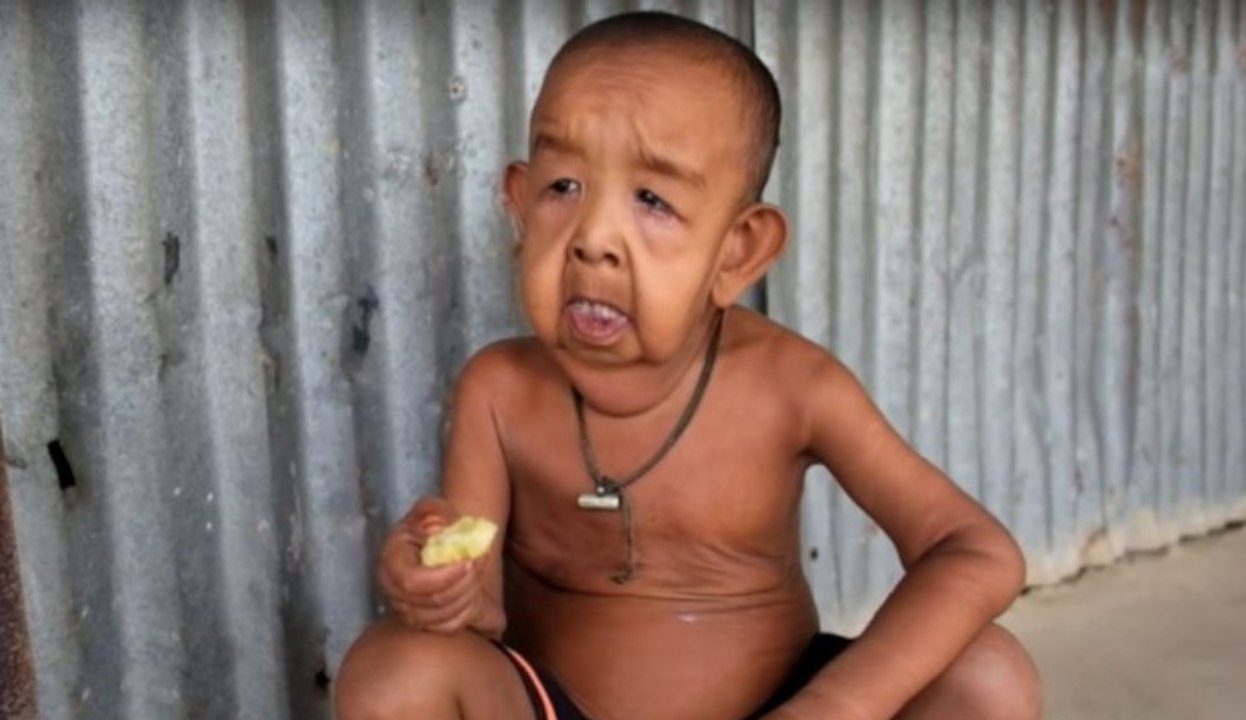 'Benjamin Button aus Bangladesh': Dieser kleine Junge sieht aus wie ein 80-Jähriger