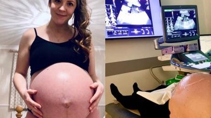 After Losing Her Baby at 18 Weeks, She Decided to Continue Her Pregnancy